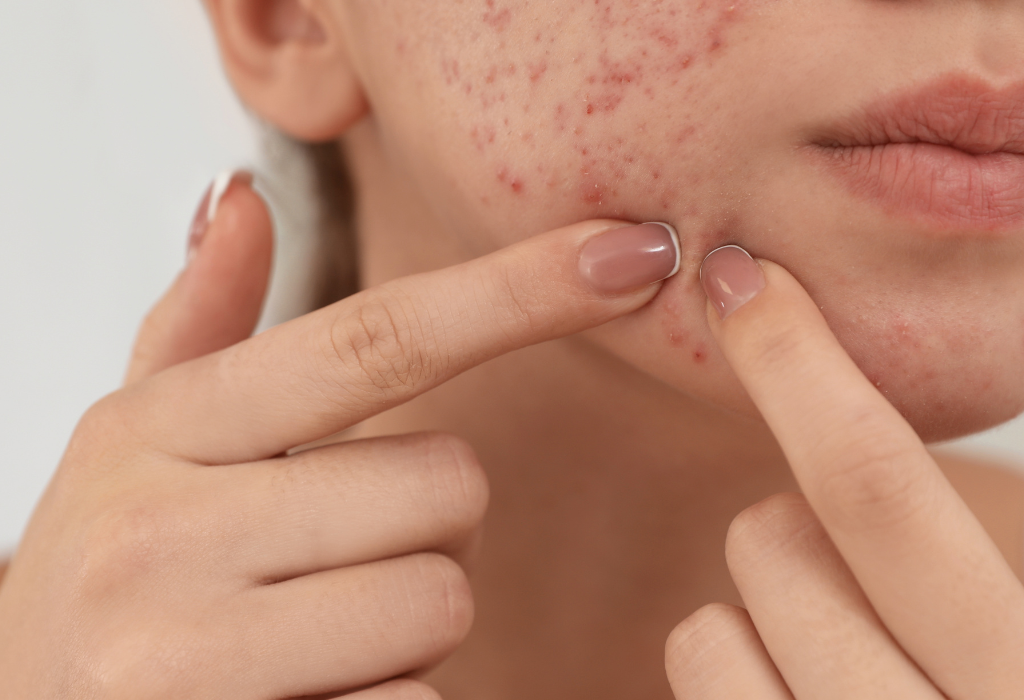 Acne treatment at Puran Hospital